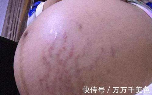肚子|孕妇肚子上有条黑线,是什么原因呢?需要祛除么?