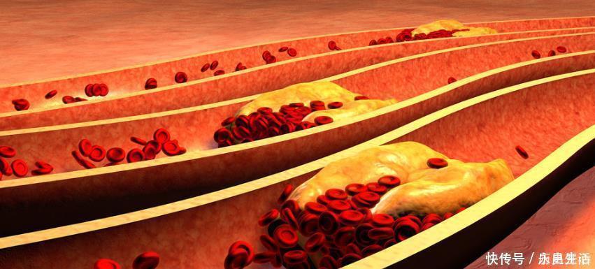 乌麦霜|腿部有5症状,可能血脂高了,做好1件事,不出1个月,血脂降了