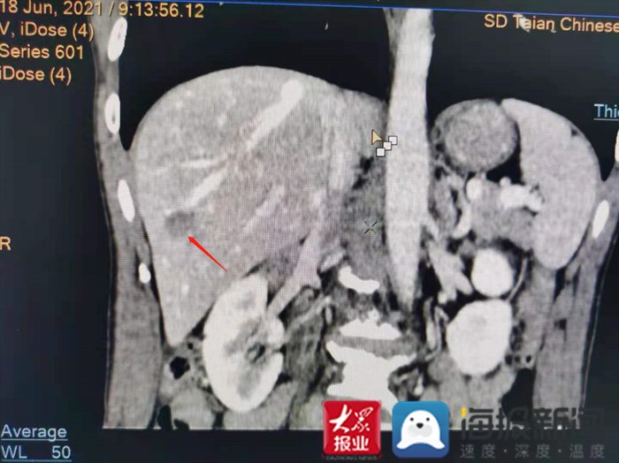 患者|“小针治大病”！泰安市中医医院为直肠癌术后患者成功实施肝脏肿瘤微波消融术