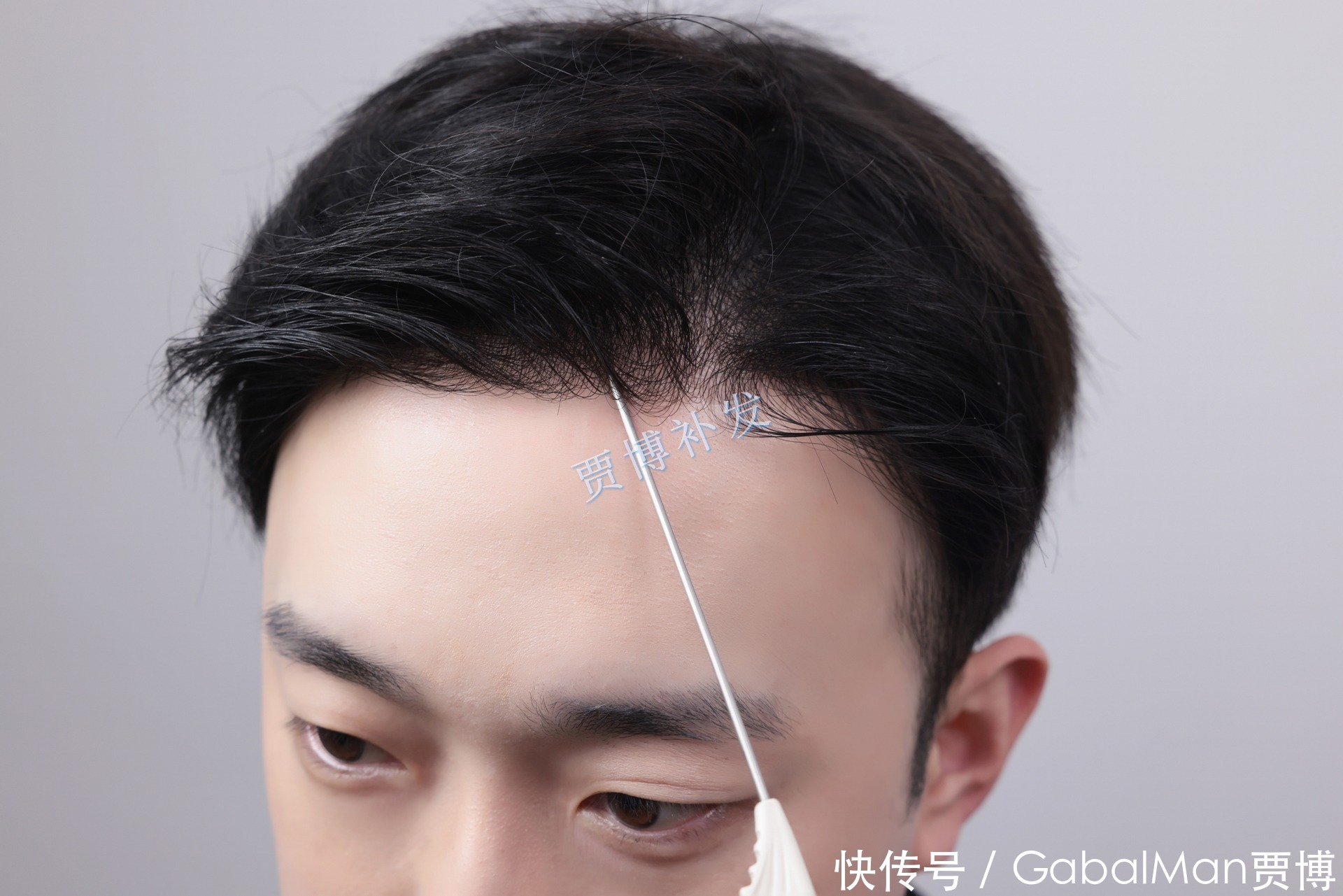 发际线脱发|60分钟拯救你的发际线!告别高额头,让你更显年轻