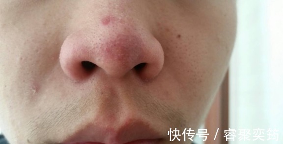 异常|头部出现3种异常,肺脏或已奄奄一息,发现其一,养肺不能再拖