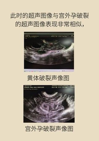 诱因|这种腹痛常被误任宫外孕，背后诱因要牢记