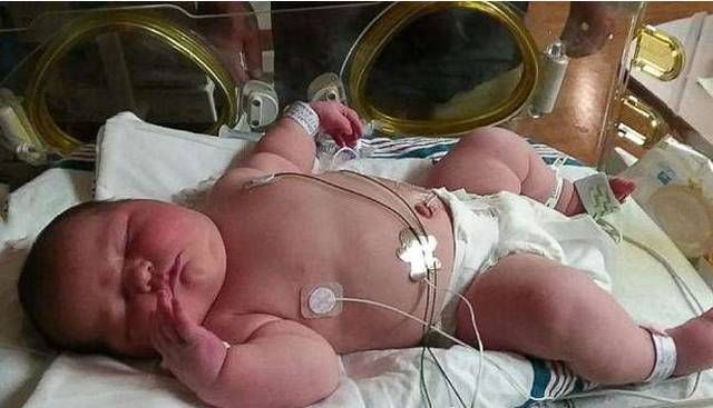 女婴|孕妇以为自己怀了双胞胎，剖腹产下宝宝后，宝妈太意外