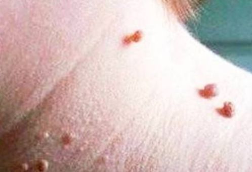 癌症|无论男女,身上若无2个“凸起”,恭喜!“癌细胞”还没有缠上你