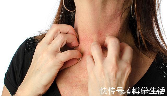 皮肤病|皮肤病的死敌是硫磺皂,这些真相你知道吗?