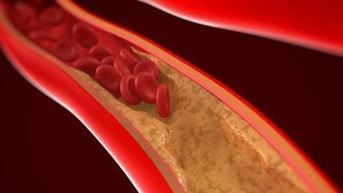 心脑血管疾病|甘油三酯飚高？1种水坚持喝15天，狂降甘油三酯，连血脂也跟着