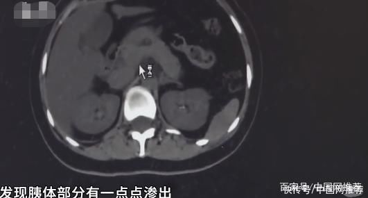 icu|29岁女生被诊断为爆发型糖尿病，多项指标严重异常住进ICU