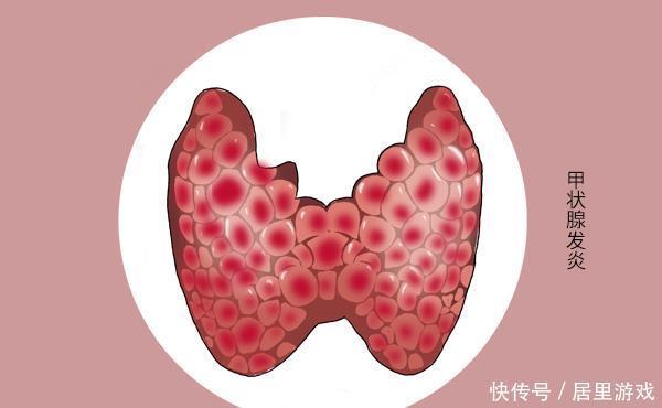 蔬菜|十字花科蔬菜和甲狀腺到底啥關系?是防癌,還是促結節(jié)?告訴你