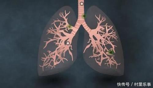 日常生活中|身体出现这4个表现,可能肺癌早期的信号,还请及时就诊检查