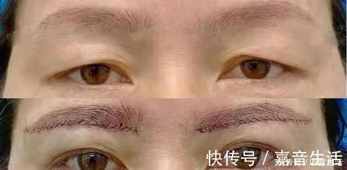 严重者 提眉手术多久恢复自然？提眉手术可以维持多久？提眉手术疼吗？