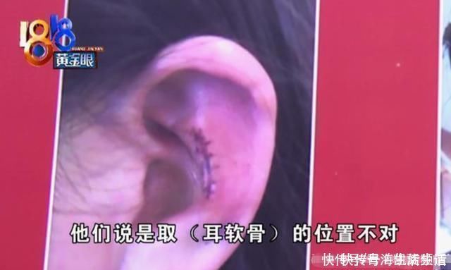 谢女士|女子取耳软骨垫鼻尖,鼻子好了耳朵却“炸”了戴口罩都很不舒服