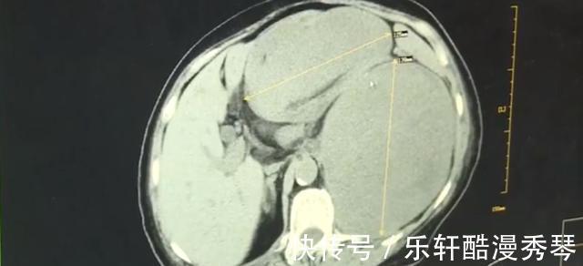 医生|恶性肿瘤1个变3个,挤满女子腹腔,医生直呼没见过!