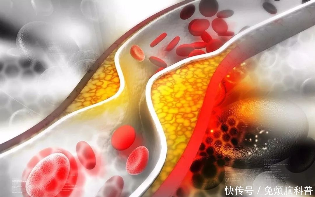 脑中风|多数中老年人对于高血压只知其一不知其二，全面了解更有助于健康