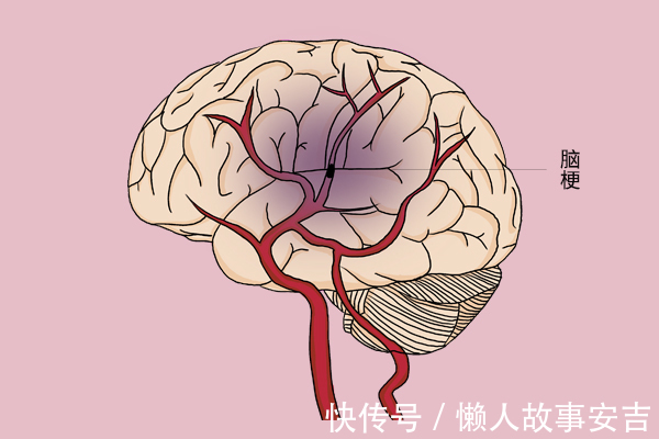 营养物质|轻度脑梗的信号是什么？身体的“求救信号”别忽视，趁早就医