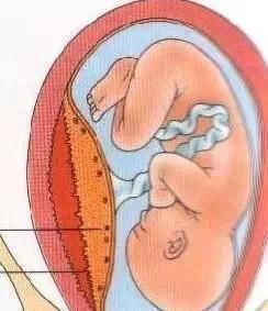 凶险性|分娩时,出现以下8种情况的产妇务必选择剖腹产,千万别犹豫误事