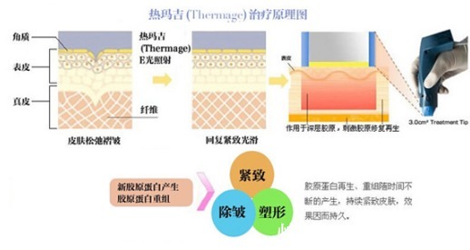 胶原蛋白 热玛吉价格一般是多少？千万别掉坑！