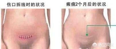 剖腹产|宝妈剖腹产十六天了,包的刀口能拆开了吗?拆后怎么护理?