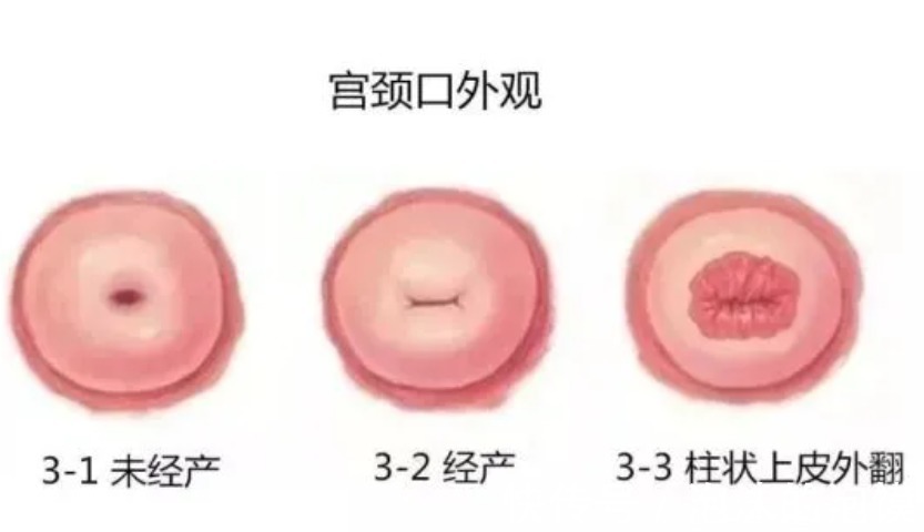 子宫口|女人是否“打过胎”,妇科医生一看便知,嘴上的承诺不牢靠