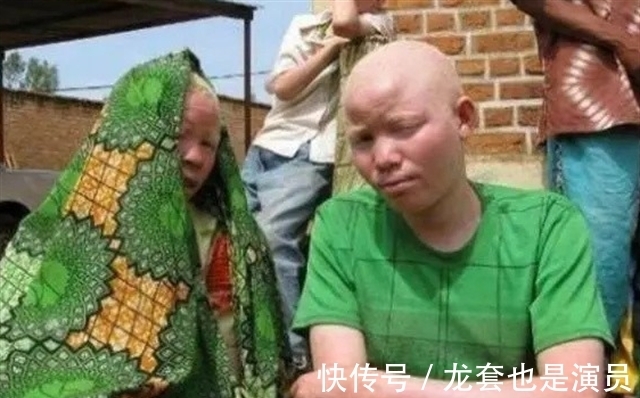 病人@非洲版“唐僧”:皮肤全白,血液比黄金还贵,死后遗骸能卖上百万