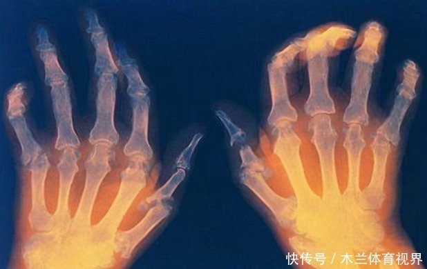 糖尿病|倾家荡产也没用,医生:这4种疾病目前无法治愈,莫花冤枉钱