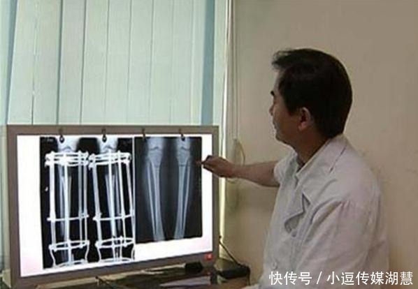 6年前,那个锯断骨头只为增高7厘米的高中生,现