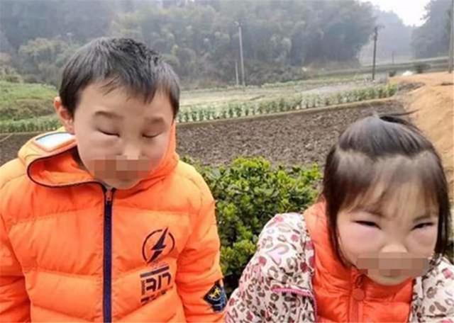 安全意识|熊孩子兄妹误捅马蜂窝,脸肿得爹妈不敢认,网友:不该笑但忍不住