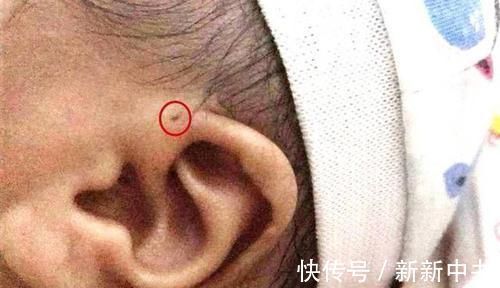 沙土堆|你家宝宝耳朵上有“富贵洞”吗?如果有,家长们可要多留心了