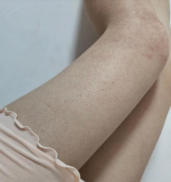 夏季穿衣不敢露肤?鸡皮肤女生做好这些