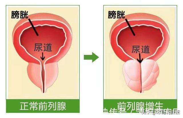 老年男性前列腺