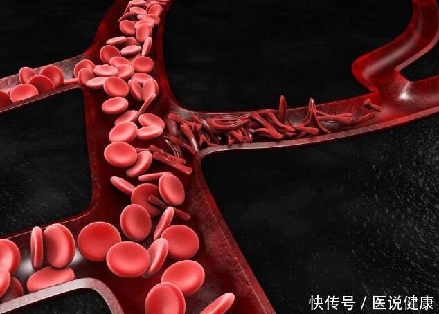饮食习惯|为什么血管会堵住?医生直言:原因无非4个,少碰才好!