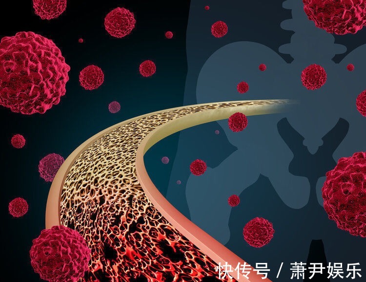 淋巴管|癌症转移速度有多快?为啥有人很快就转移了?或和4个原因有关