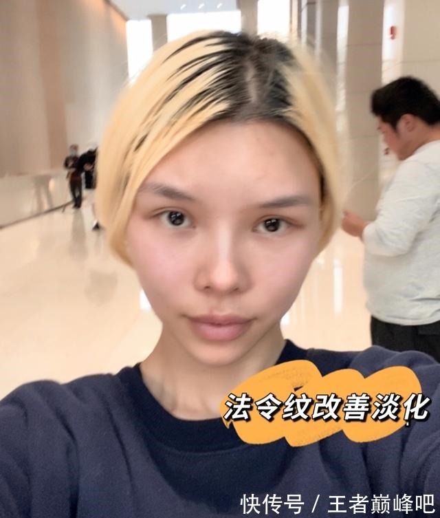 紧致 面部抗衰老,选热玛吉还是线雕提升!