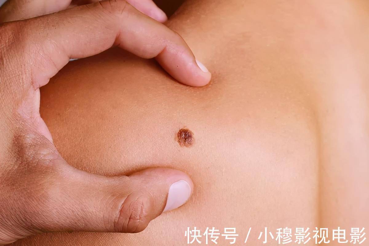黑痣|身上出现4个小变化,当心肝癌、乳腺癌盯上你!洗澡时看一眼、摸一下能救命