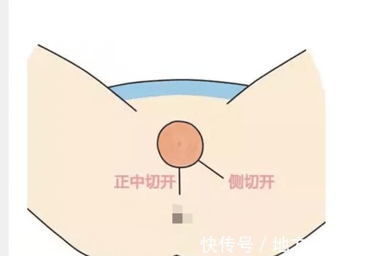 会阴|明明是顺产,还要挨一刀,产科医生避免侧切,做好这5点很重要
