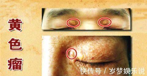 游离脂肪酸|甘油三酯过高怎么办坚持5件小事，清理血管垃圾、甘油三酯降了