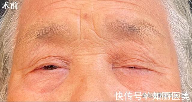 切口 双眼皮越宽眼睛就越大吗?医生揭开双眼皮手术的5个“真相”!