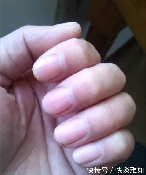 半月痕|手指甲上有月牙的人,与没有月牙的人,谁的身体更健康?