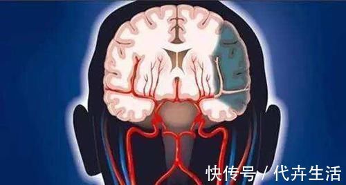 头晕头痛|一旦头上出现三种异常,说明体内有血栓了,常吃5物,脑梗不扰
