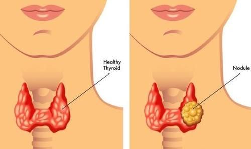  甲状腺有结节的人，常吃三物，帮你活血散结，结节可能会悄悄好转