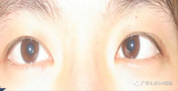 眼珠子|连续玩几小时手机，小伙眼珠子“斜”了