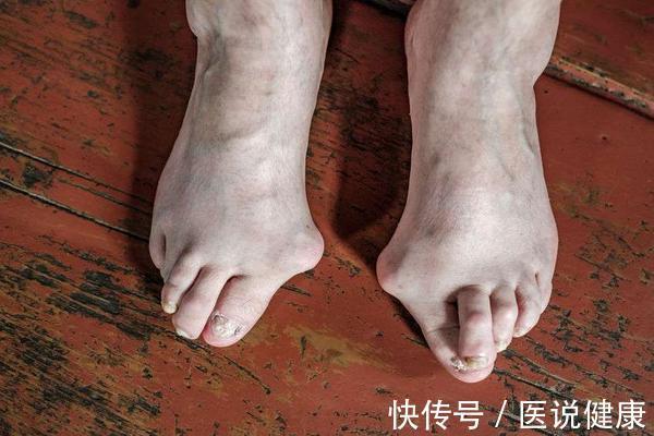 患者|明明都是高尿酸血症,为什么自己却出现痛风,看完你就了解了