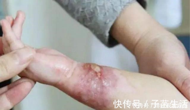 家长|孩子烫伤后最佳救治时间只有90秒,第一步该做啥很多父母都做错