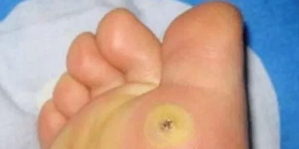 修剪|脚上长“茧子”和疾病有关？若脚上出现4种茧子，一定要留意了！