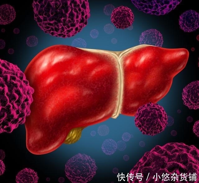 肝会|肝癌多是“吃”出来的,这5样东西,如果不碰,你肝会更健康!