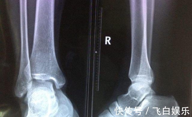 营养均衡|“骨骼闭合”前,身体会发出3信号,家长及时发现身高还能窜一窜