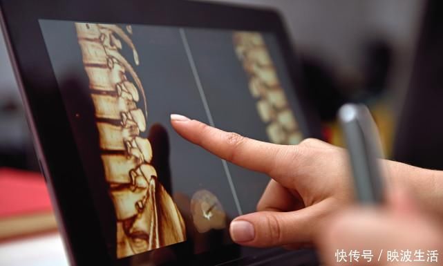 关节积液|骨科主任：一块干姜，关节积液消了，腿不疼了，滑膜炎不攻自破