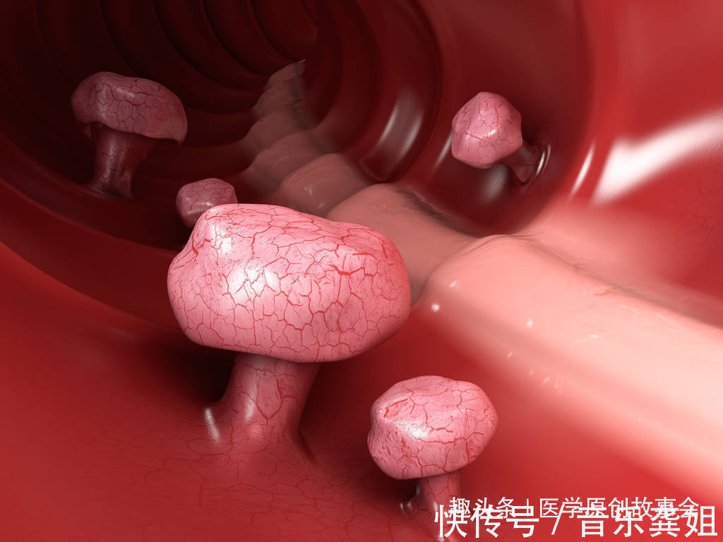 肠镜|三种息肉一旦发现,最好及时切除,一拖再拖会变成恶性肿瘤