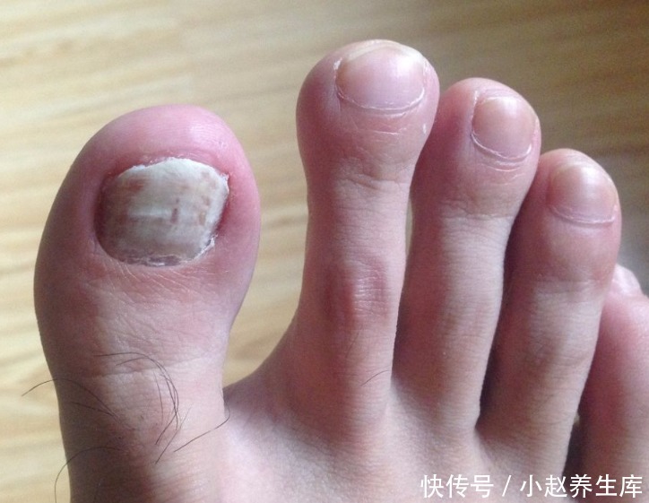  提醒|提醒：脚上出现6种表现，说明你的血糖太高了，小心糖尿病足