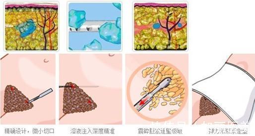 收费标准 抽脂手术动图演示手术原理!效果好吗?价格+选择攻略,助力好身材!