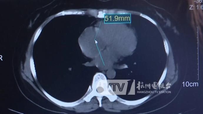 国科大|罕见！36岁妈妈以为肺炎胸闷气喘，一查竟是心上长了肿瘤！